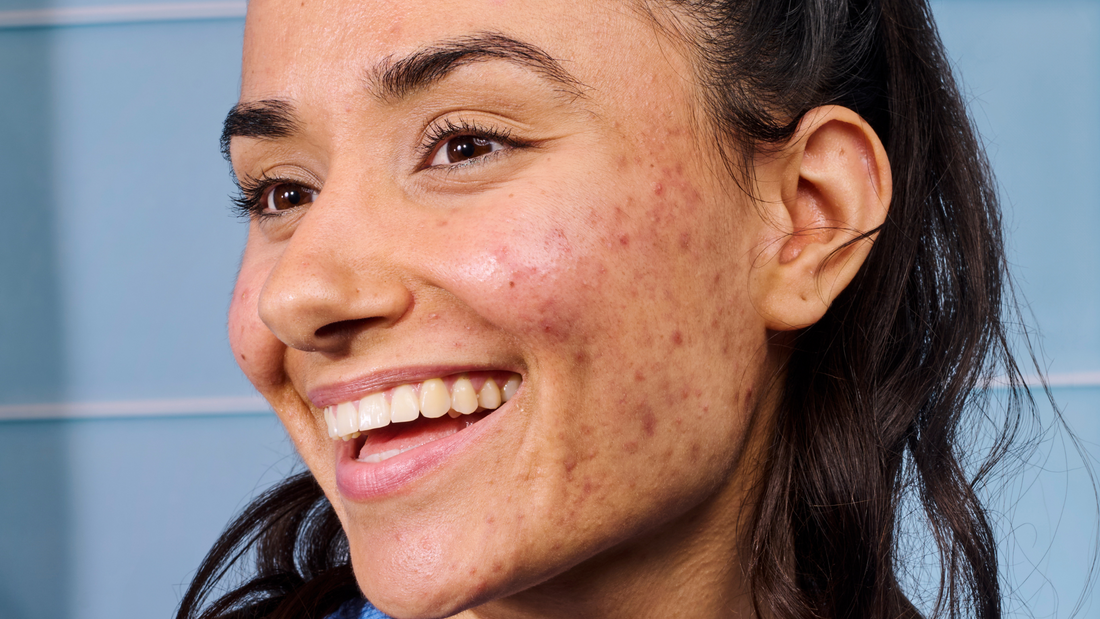 ¿Qué hábitos ayudan a cicatrizar los granos? Guía completa para recuperar tu piel