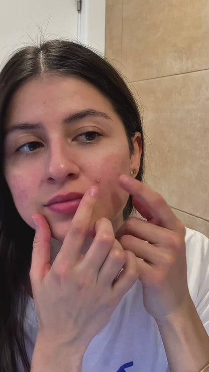 Pack On The Go – Pimple Patch Kit